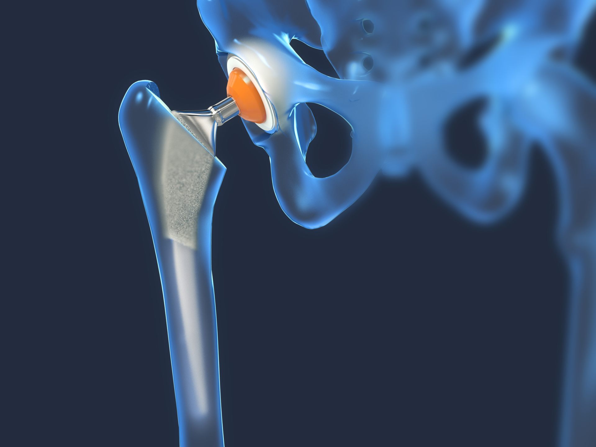 Hip Joint Implant - Titanium Anodizing (1)